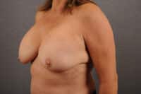Breast Lift