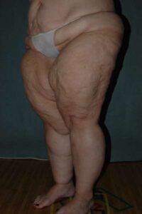 Thigh Lift