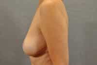 Breast Lift