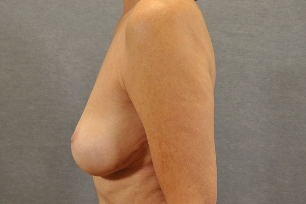 Breast Lift