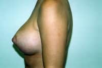 Breast Lift