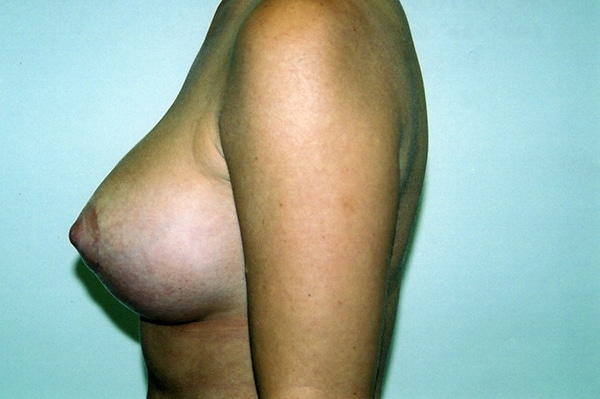 Breast Lift