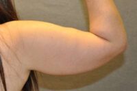 Arm Lift