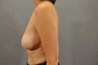Breast Lift