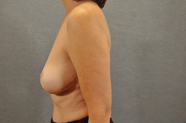 Breast Lift