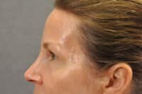 Brow lift