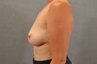 Breast Implant Removal