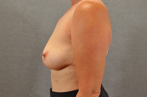 Breast Implant Removal