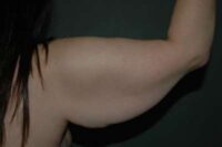 Arm Lift