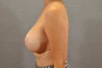Breast Lift