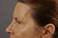 Brow lift
