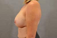 Breast Implant Removal