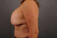Breast Lift