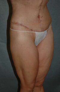 Belt Lipectomy