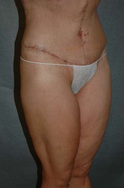 Belt Lipectomy
