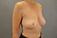 Breast Lift