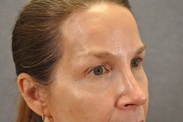 Brow lift