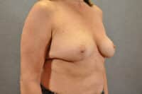 Breast Lift