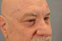 Eyelid Lift
