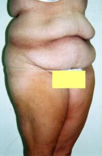 Belt Lipectomy