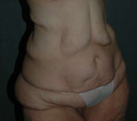 Belt Lipectomy