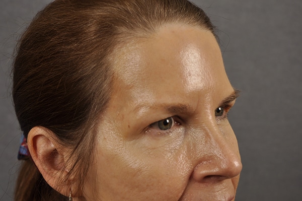 Brow lift