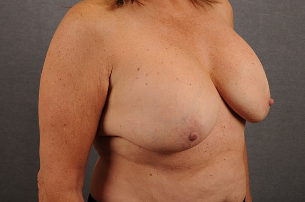 Breast Lift