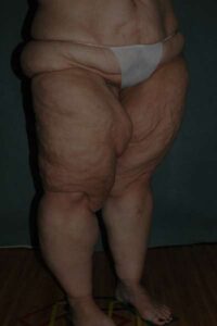 Thigh Lift