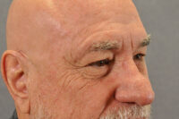 Eyelid Lift