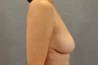 Breast Lift