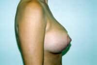Breast Lift