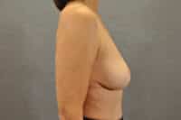 Breast Lift