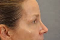 Brow lift