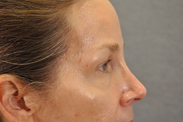 Brow lift