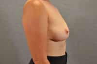 Breast Implant Removal