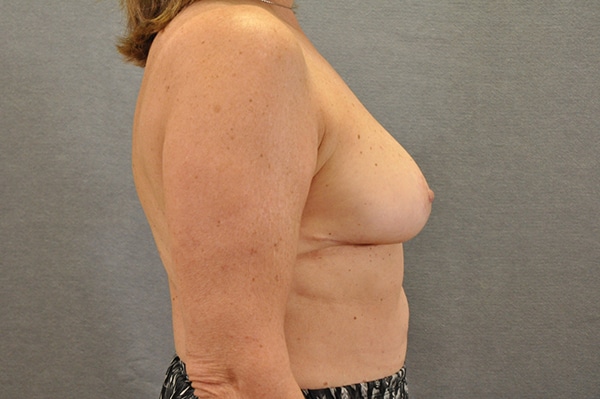 Breast Lift