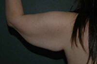 Arm Lift