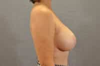 Breast Lift