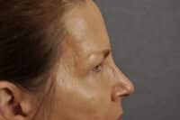 Brow lift