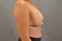 Breast Implant Removal