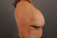 Breast Lift