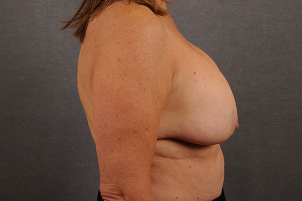 Breast Lift