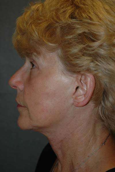 Facelift