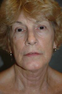 Facelift