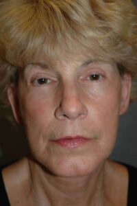 Facelift