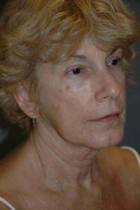 Facelift