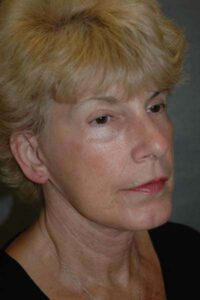 Facelift