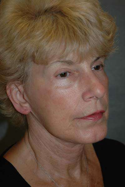 Facelift