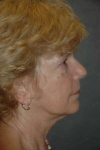 Facelift
