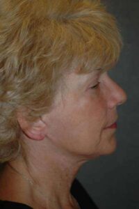 Facelift